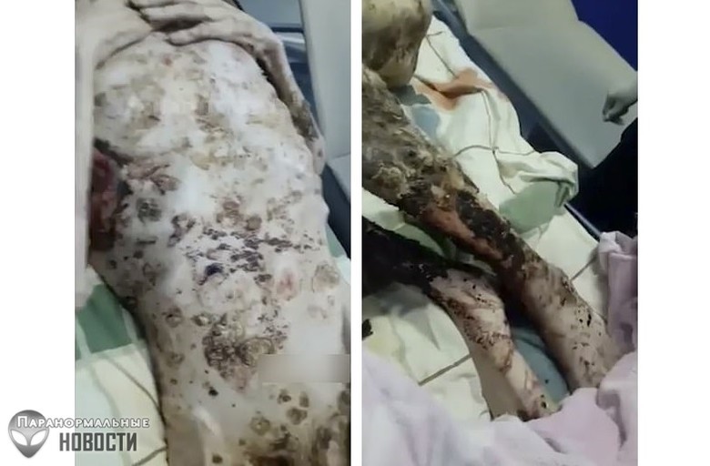 Живой труп: Мужчина со сломанной спиной месяц пролежал в медвежьей берлоге и выжил (Осторожно! Шокирующий контент! 18+) | Человек 
 
 