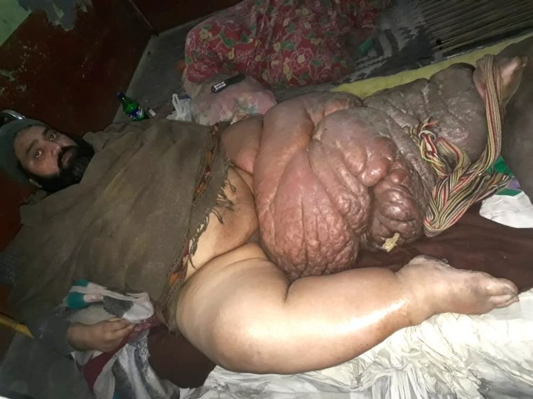 Пакистанец с громадной ногой согласен на ампутацию (Осторожно! Шокирующий контент 18+)
 
 
 