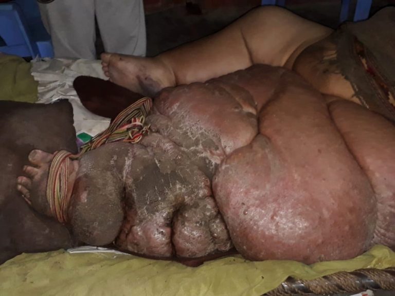 Пакистанец с громадной ногой согласен на ампутацию (Осторожно! Шокирующий контент 18+)
 
 
 